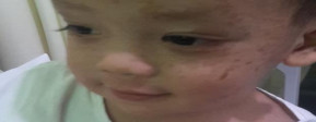 Anakku Terkena Staphylococcal Scalded Skin Syndrome (SSSS)