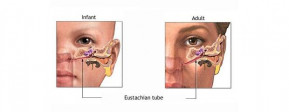 Otitis Media pada Anak