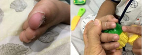 Perawatan Penyakit Kawasaki setelah Pulang dari RS