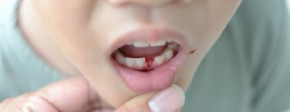 Mengurangi Rasa Takut Anak Saat Giginya Akan Tanggal