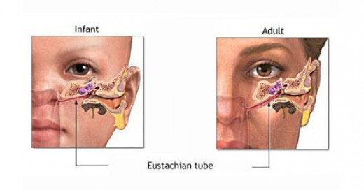 Otitis Media pada Anak